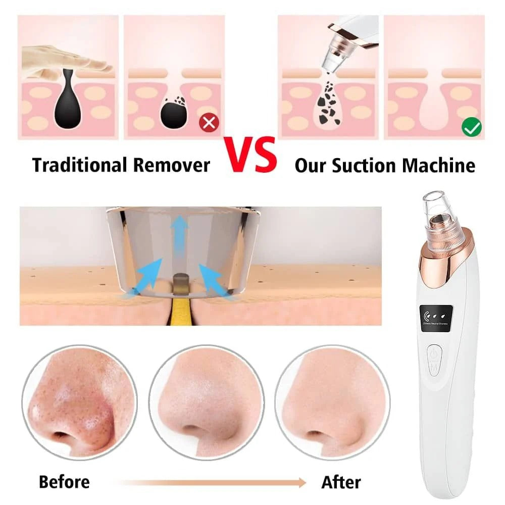 Electric Pore Cleaner & Acne Remover Facial Tool